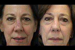 Results OF Facial Scar Revision Clinic in Dubai