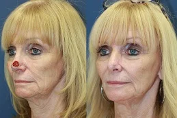 Results OF Facial Scar Revision Clinic in Dubai.