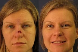 Results OF Facial Scar Revision Cost Dubai