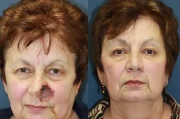 Results OF Facial Scar Revision Cost in Dubai