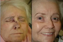 Results OF Facial Scar Revision Dubai