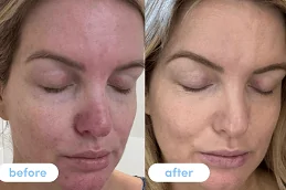 Results OF Liposomal Glutathione Injections Clinic Dubai