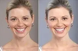 Results OF Liposomal Glutathione Injections Dubai
