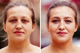 Results OF Liposomal Glutathione Injections in Dubai