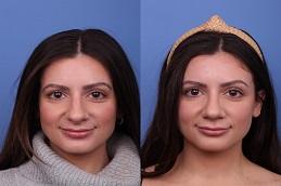 Results OF Nose Tip Plasty Cost in Dubai