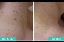 Results OF Skin Lesion Removal Cost Dubai