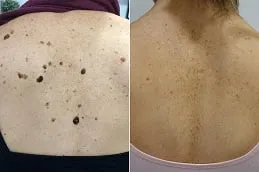 Results OF Skin Lesion Removal Cost in Dubai.