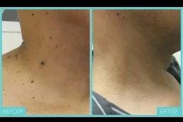 Results OF Skin Lesion Removal Cost in Dubai