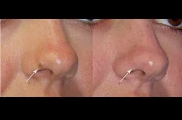 Results OF Skin Lesion Removal Cost in Dubai.