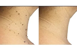 Results OF Skin Lesion Removal Dubai