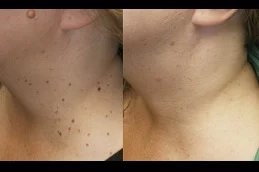 Results OF Skin Lesion Removal