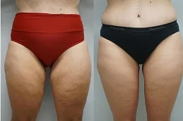 Results OF Thigh Lift Cost Dubai