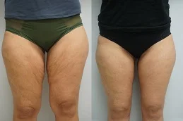 Results OF Thigh Lift Cost in Dubai