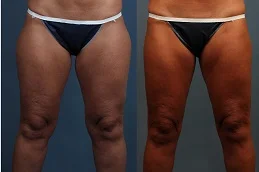 Results OF Thigh Lift Dubai