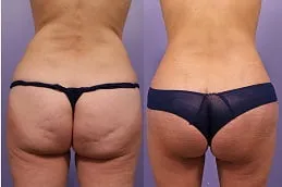 Results OF Thigh Lift Dubai,