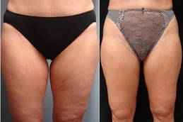 Results OF Thigh Lift clinic Dubai
