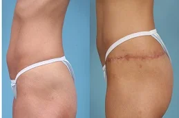 Results OF Thigh Lift clinic in Dubai