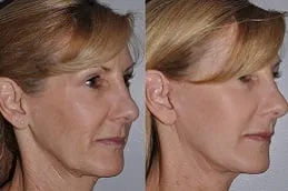 Results of Facelift Surgery clinic Dubai