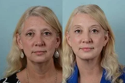 Results of Facelift Surgery clinic in Dubai & Abu Dhabi