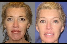 Results of Facelift Surgery clinic in Dubai