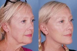 Results of Facelift Surgery in Dubai & Abu Dhabi