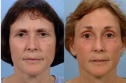 Results of Facelift Surgery in Dubai & Abu Dhabi,