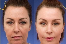 Results of Facelift Surgery in Dubai