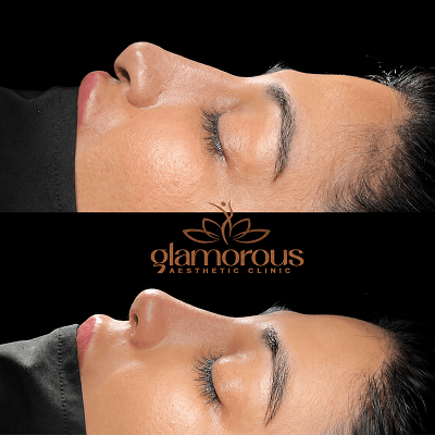 Rinoplasty in Dubai & Abu Dhabi,