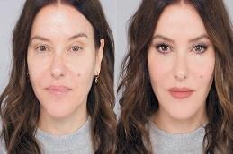 lip Augmentation Before & After Dubai,