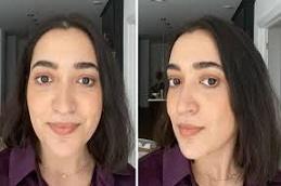 lip Augmentation Before & After,