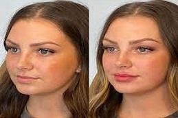 lip augmentation before & after Dubai & Abu Dhabi,