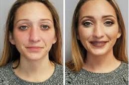 lip augmentation before & after Dubai & Abu Dhabi