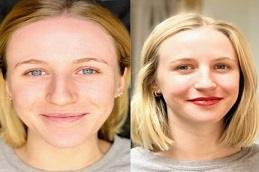 lip augmentation before & after clinic Dubai & Abu Dhabi