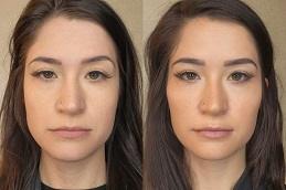 lip augmentation before & after in Dubai & Abu Dhabi