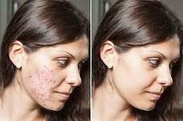 Cortisone Injection before & After in Dubai