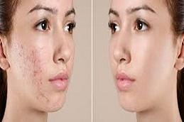 Cortisone Injection before & After in Dubai & Abu Dhabi