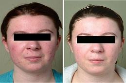 Cortisone Injection before & After in Dubai