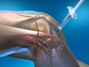 Knee Injections Before & After