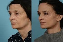 Results OF Deep Plane Facelift Dubai