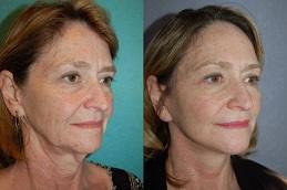 Results OF Deep Plane Facelift clinic Dubai