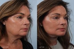 Results OF Deep Plane Facelift clinic in Dubai