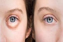Results OF Puffy Eyes Treatment Dubai