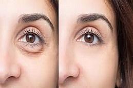 Results OF Puffy Eyes Treatment clinic Dubai