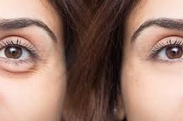 Results OF Puffy Eyes Treatment clinic in Dubai & Abu Dhabi