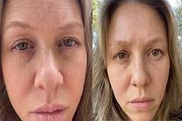 Results OF Puffy Eyes Treatment clinic in Dubai