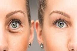 Results OF Puffy Eyes Treatment in Dubai