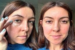 Results OF Puffy Eyes Treatment in Dubai.