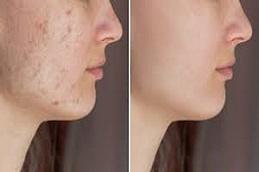Results of Cortisone Injection Dubai