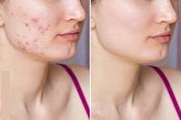 Results of Cortisone Injection clinic Dubai