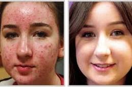 Results of Cortisone Injection clinic in Dubai